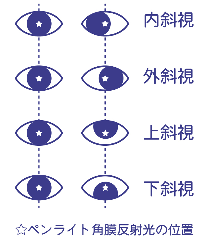 子供の弱視・治療について